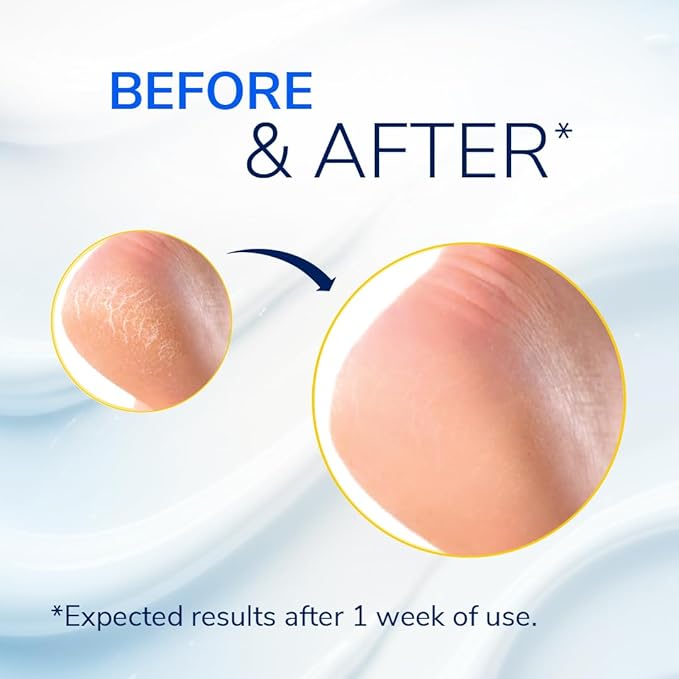 Dr. Scholl's Severe Cracked Heel Repair Restoring Balm 2.5oz, with 25% Urea for Dry, Cracked Feet, Heals and Moisturizes for Healthy Feet