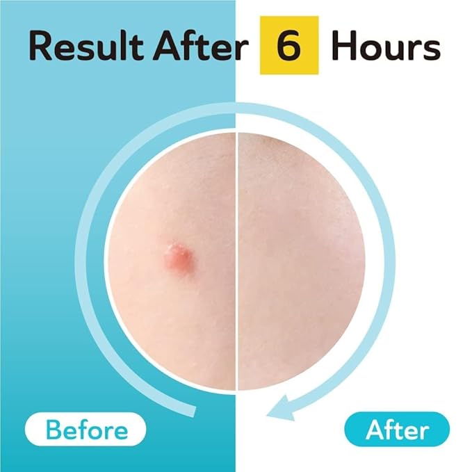 DERMA ANGEL Ultra Invisible Salicylic Acid Acne Patches and Post Acne Dark Spot Patches Bundle - Day and Night Use - UPGRADED