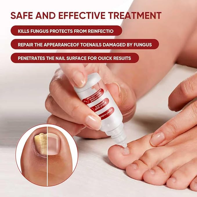 Toenail Treatment,Gentle Formula, Effectively Improves Nails for a More Beautiful Appearance（2pcs）