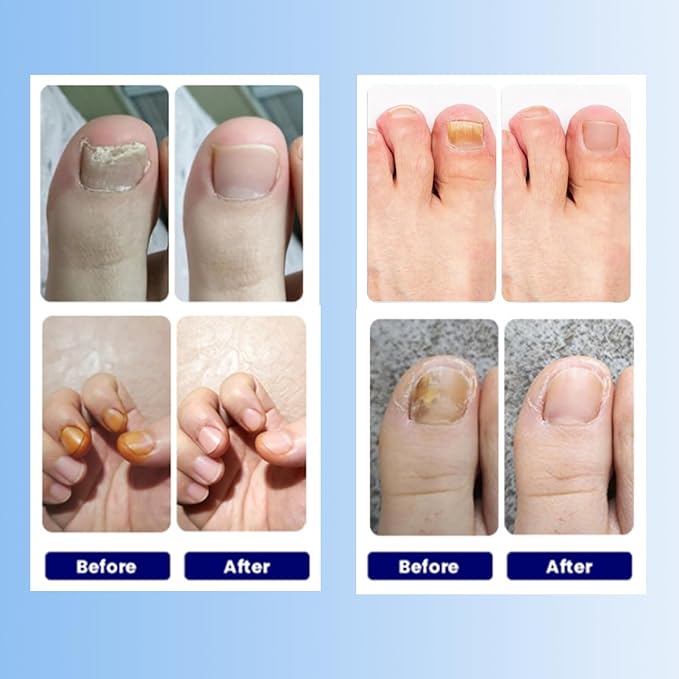 Toenail Fungus Treatment Extra Strength - 42 Pcs Fungal Nail Patches, Foot Nails Repair & Strengthen Patches for Women & Men (2 Count (Pack of 21))