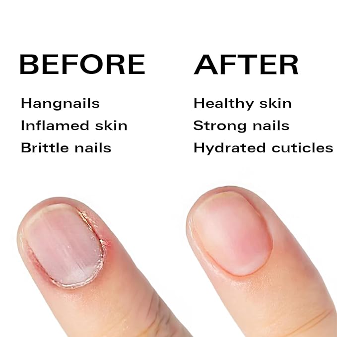 Nail Oil Cuticle Pen - Pineapple - Nail Strengthener & Growth Serum with Vitamin A, D, E, B5, Grapeseed & Natural Oils - Repair for Brittle, Peeling, Thin Nails - Twist Brush Pen