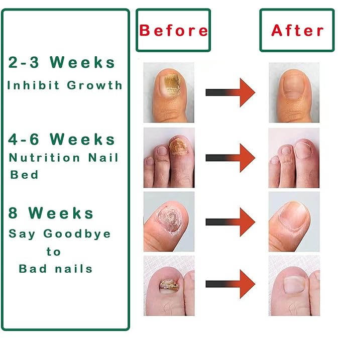 Nutraboost Nail Fungus Treatment Gel - 2 PCS Nail Growth Repair Cream for Fingernails and Toenails, Fix & Renew Damage Fungal Nail, Broken, Cracked & Discolored Nails