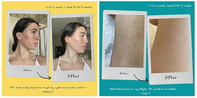 Plant-Based Kale Face Body Exfoliating Scrub Mask for Keratosis Pilaris Treatment, Strawberry Legs Treatment, Cellulite, Stretch Marks, Blackheads
