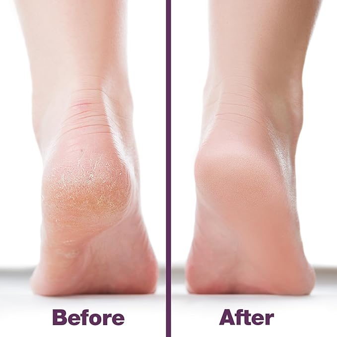 Probelle Double Sided Multidirectional Nickel Foot File Callus Remover - Immediately Reduces calluses and Corns to Powder for Instant Results, Safe Tool (Purple)