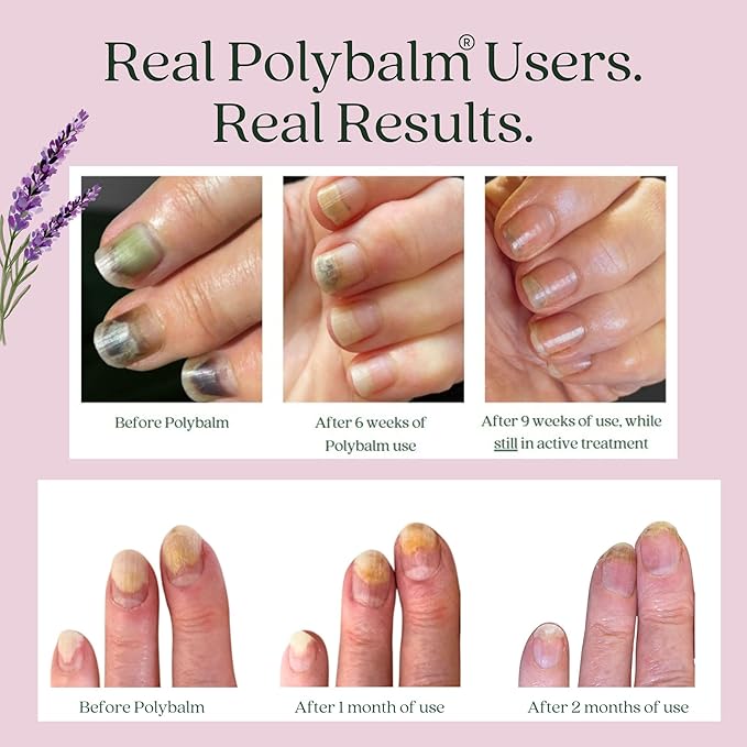 CLINICALLY PROVEN for Weak, Brittle, Damaged Nails | 100% Natural Nail Repair Balm | Doctor Developed to Strengthen Nails Damaged by Gel or Nail Salon Manicures, Menopause & Aging | Made in the UK