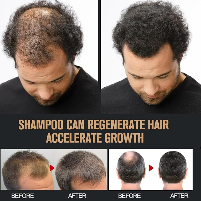 2 Pcs Root Activator Shampoo, Hair Growth Root Activator Shampoo, For Anti-Hair Loss, Natural Formula for Men and Women