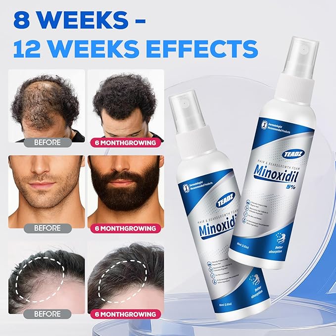 5% Minoxidil for Men and Women，Minoxidil hair growth products，Intense Hair Growth Serum，May Promote Faster, Stronger, Thicker Hair Growth to Fight Hair Loss and Thinning Hair（2.82 oz*2）