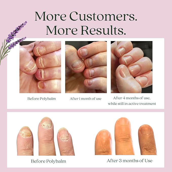 CLINICALLY PROVEN for Weak, Brittle, Damaged Nails | 100% Natural Nail Repair Balm | Doctor Developed to Strengthen Nails Damaged by Gel or Nail Salon Manicures, Menopause & Aging | Made in the UK