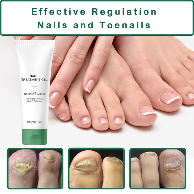 Nutraboost Nail Fungus Treatment Gel - 2 PCS Nail Growth Repair Cream for Fingernails and Toenails, Fix & Renew Damage Fungal Nail, Broken, Cracked & Discolored Nails