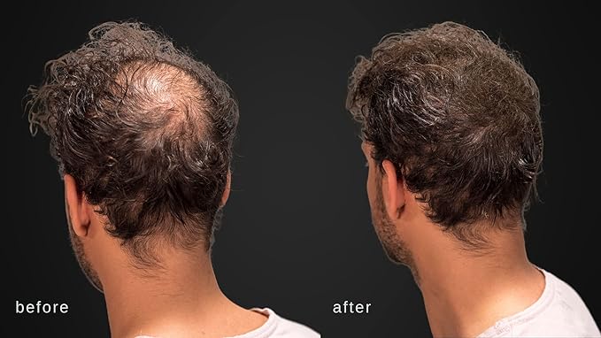 Hair Building Fibers - Volumizing Hair Fibers with real Keratin for Thinning Hair/Hair Loss Dermatologist Tested and Certified Hypoallergenic - 60 days + supply(Dark Brown)