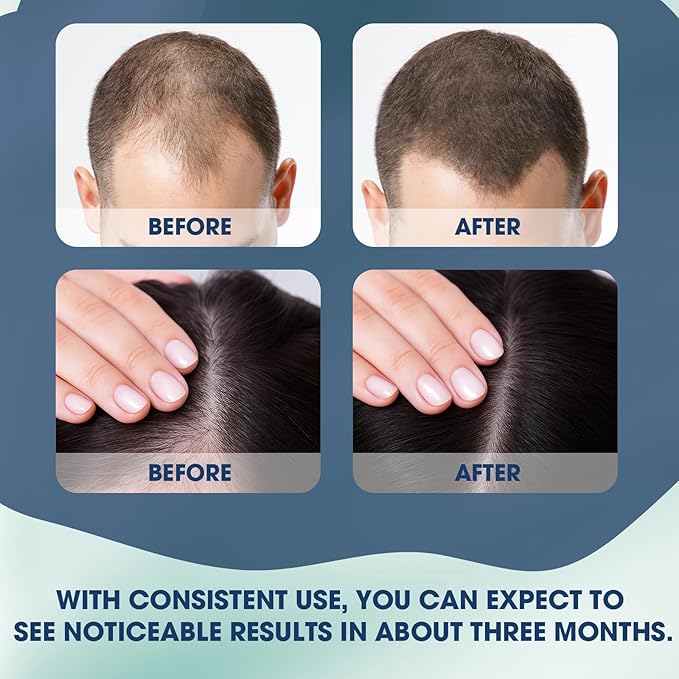 25ML Hair Growth Serum Roll On, Suitable for All Hair Types Prevents Hair Loss Nourishes Hair Follicles Achieve Thicker Hair for Men & Women