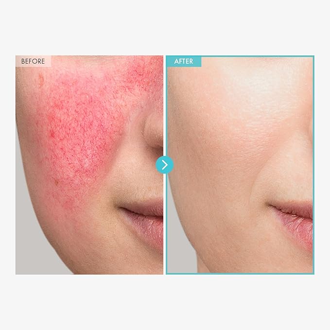 TOSOWOONG SOS Repair CICA Clinic Zinc Cream, 100,000ppm Zinc Oxide, Heal, Soothe Acne, Redness, Rosacea Treatment, Skin Barrier Repair, Moisture, Non-Comedogenic, Korean Skincare, 50g, 1.76 oz.
