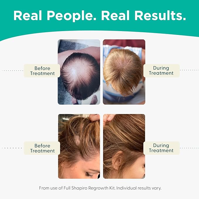 Shapiro MD Hair Growth Experts Shampoo and Leave in Conditioner, DHT Fighting Vegan Formula for Thinning Hair Developed by Dermatologists, Experience Healthier, Fuller Thicker Looking Hair, 1 Month
