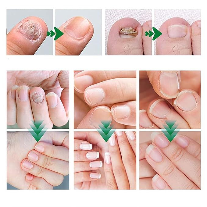 Orvalle Nail Fungus Pen, Nail Growth Treatment Repair Serum Twist Pen Activator for Repair & Strengthener (3)