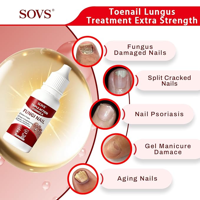 Toenail Treatment,Gentle Formula, Effectively Improves Nails for a More Beautiful Appearance (1Pcs, 1 oz)