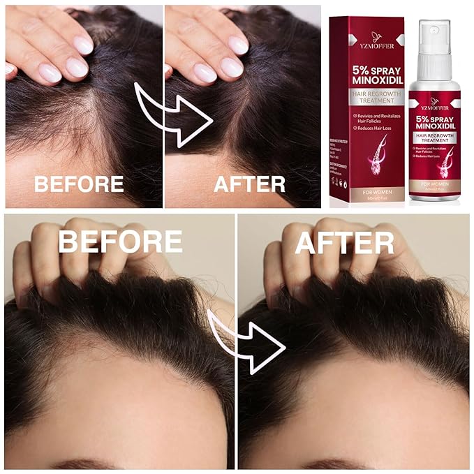 Women's 5% Minoxidil Serum: Hair Spray for Hair Thinning and Hair Loss to Get Thicker and Fuller Hair, 60ML