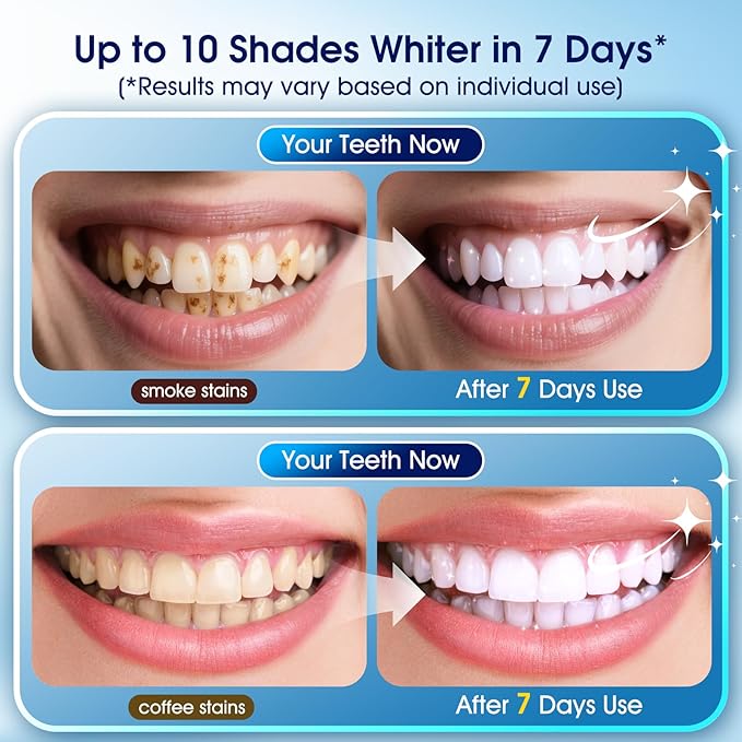 Teeth Whitening Kit – 3 Teeth Whitening Pens + 2 Desensitizing Pens – LED Light – 35% Carbamide Peroxide – Safe & Dentist-Recommended – Fast 7-Day Visible Whitening + Remineralizing Care(Grape)