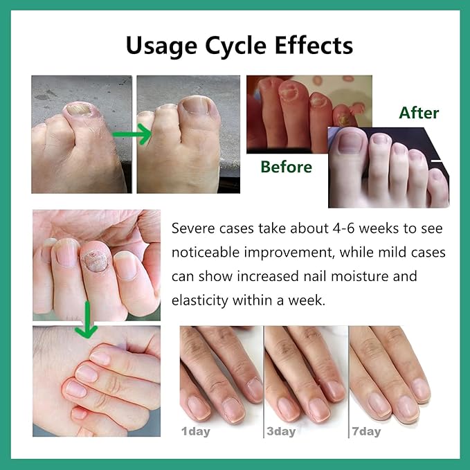 Natural Nail Care Gel, Nutraboost Strengthening Cuticle Serum for Damaged & Brittle Nails, 20ml (1 pcs) (3pcs)