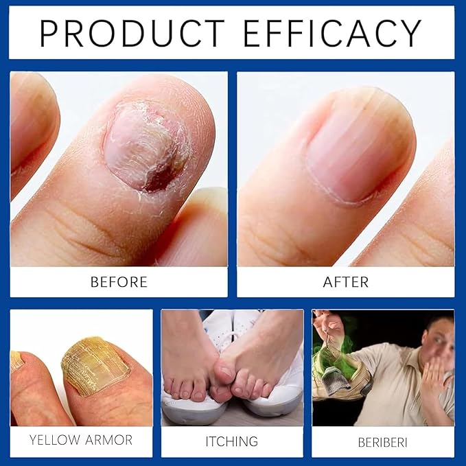Nuvira Nail Fungus Pen – with Tea tree oil and clove oil for Foot & Nail Care – Effectively repair discolored, damaged, and thickened toenails, Suitable for daily care (2pcs)