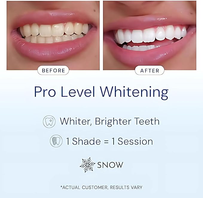 Snow Teeth Whitening Kit - Snow Teeth Whitening Serum and LED Mouthpiece Whitener, Formulated with Hydroxyapatite, Good for 2 Months - Wired Kit with 1 Wand