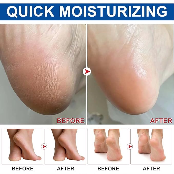 Roll On Urea Cream for Feet,Hydrating and Nourishing Foot Balm Stick,Foot Repair for Dry Skin and Rough Heels,Hands,Knees Skin Care Heel Treatment