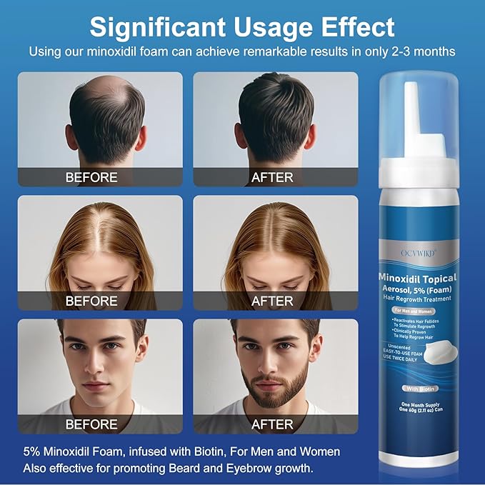 5% Minoxidil Foam, Biotin-Infused, Unisex Adult, Hair Growth Treatment, Unscented, Foam, 14.77 Ounce, 7-8Month Supply, Supports Thicker and Fuller Hair & Beard （Extra Strength）