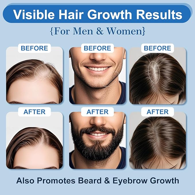 5% Minoxidil Foam with Biotin – Hair & Beard Growth Treatment for Men & Women, Fragrance-Free, Non-Greasy, 4-Month Supply (8.44oz), Clinically Trusted Formula ERYLVEKA