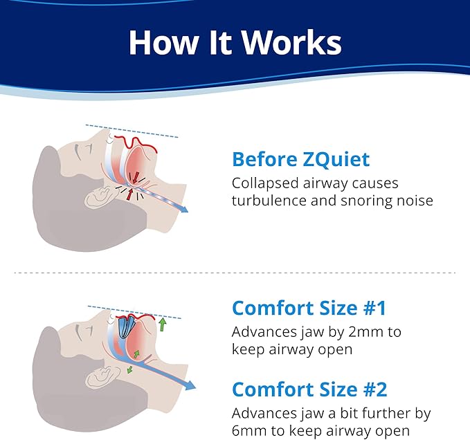 ZQuiet, Anti-Snoring Mouthpiece, Starter Pack with 2 Sizes, Living Hinge & Open Front Design for Comfort & Easy Breathing, Blue