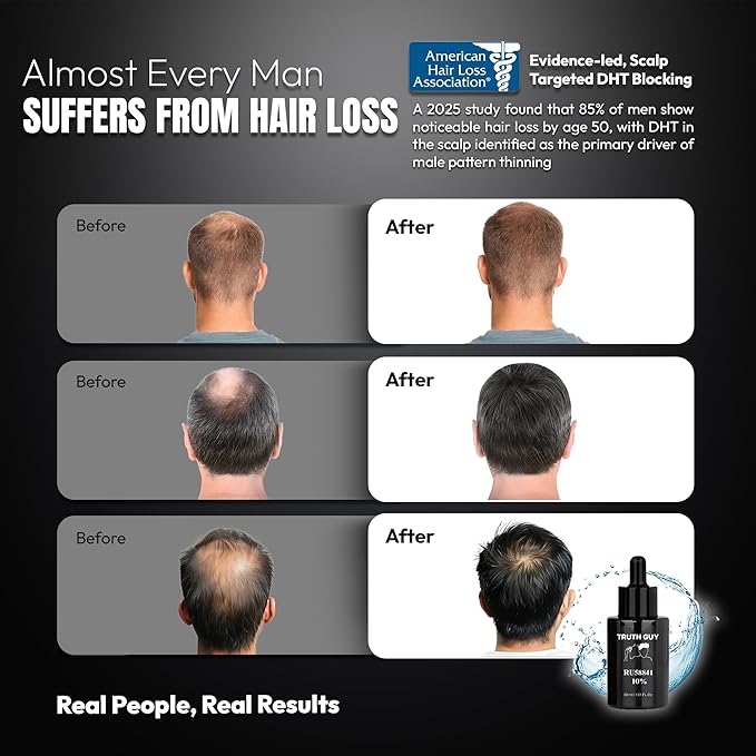 Truth Guy RU58841 10% Hair Serum for Men – Powerful DHT Blocker with Maximum Strength – Targets Male Pattern Thinning and Receding Hairline – Promotes Fuller, Healthier-Looking, Stronger Hair – 30 ml