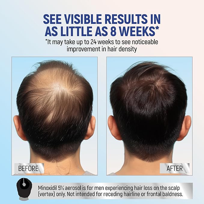 Minoxidil topical aerosol foam, 5%, hair regrowth 2 months treatment for men, 2.11 oz (2 Pack)