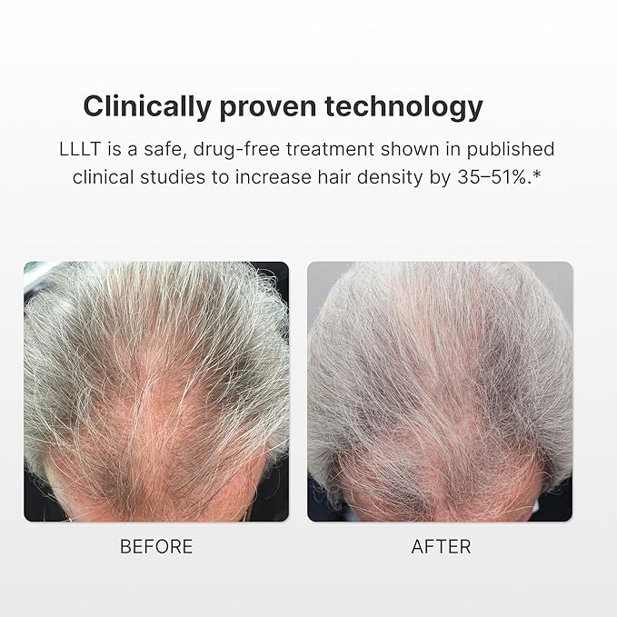 Turbo Pro Laser Hair Growth Cap with 316 Lasers – 6 Minute Treatment Time for Thinning Hair | Hair Loss Treatment | Hair Regrowth Cap for Men and Women