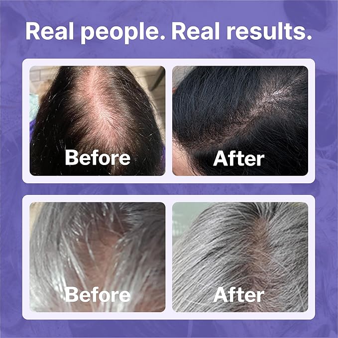 Minoxidil 2% Topical Solution for Women's Hair Growth, Serum Promotes Hair Regrowth by Reactivating Hair Follicles | Shapiro MD (6 Month)