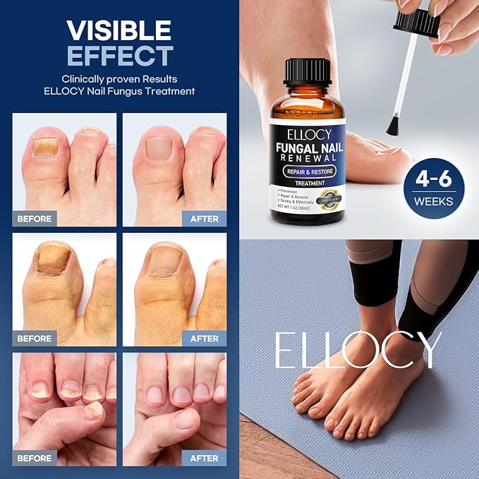 Toenail Fungus Treatment Extra Strength: Repair Damaged Toenail and Fingernail Fungus Treatment - Nail Repair Liquid 30ml