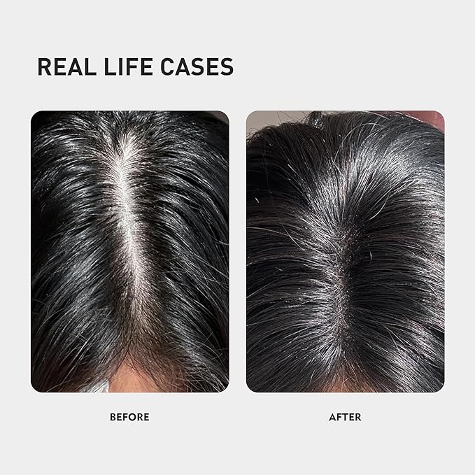 KINTOR 0.5% KX-826 Hair Growth Spray DHT Blocker Hair Regrowth Products,Nourish Hair follicles,Hair Oil Control Products For Men&Women-1 Month Supply 60ml