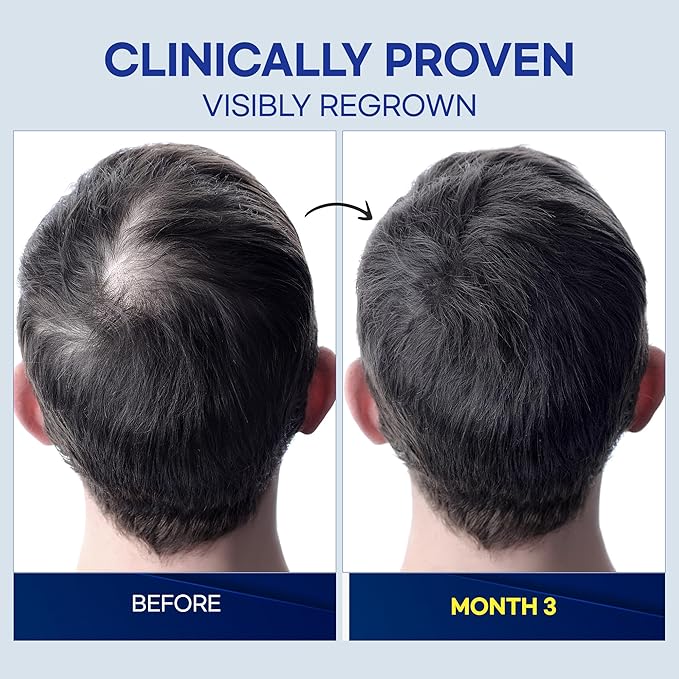 Minoxidil Hair Growth Treatment Spray: Clinically Proven 5% Minoxidil Treatment for Hair Loss & Thinning - Made in USA (2 Fl Oz (Pack of 2))