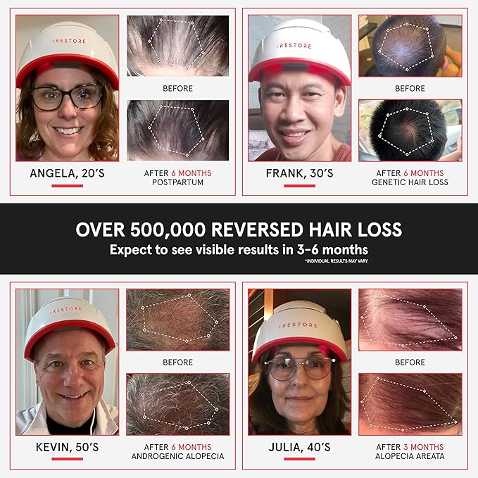iRestore Professional Laser Red Light Therapy for Hair Growth System - FDA Cleared Hair Loss, Hair Thinning & Alopecia Treatment for Men & Women - 282 Lasers & LEDs