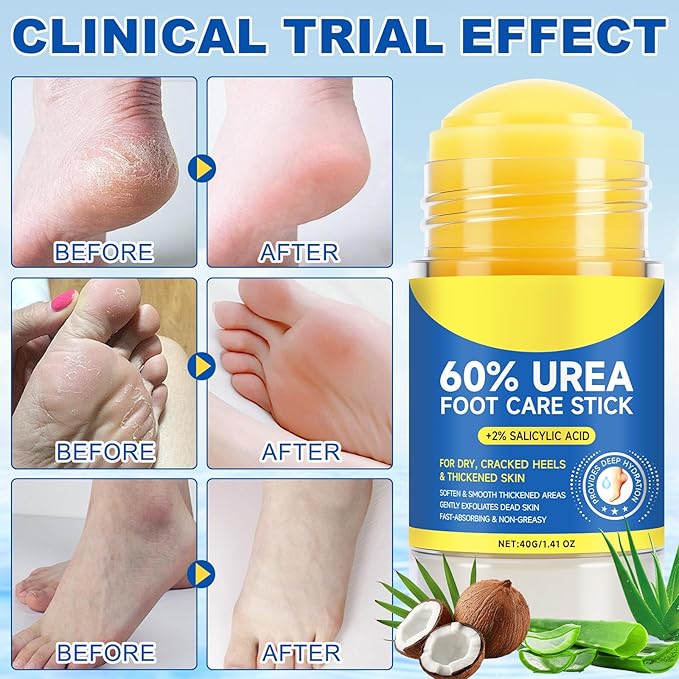 60% Urea Foot Care Stick with 2% Salicylic Acid, Foot Cream Moisturizer for Dry Cracked Feet, Knees, Elbows, Hands,Exfoliating Moisturizer, Dead Skin Remover Foot Balm 2.8oz