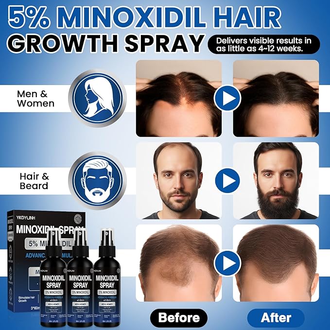 5% Minoxidil Spray,3 pack– High-Efficiency Hair Loss Product to Prevent Thinning, and Hair Regrowth Treatment for Stronger, Fuller Hair