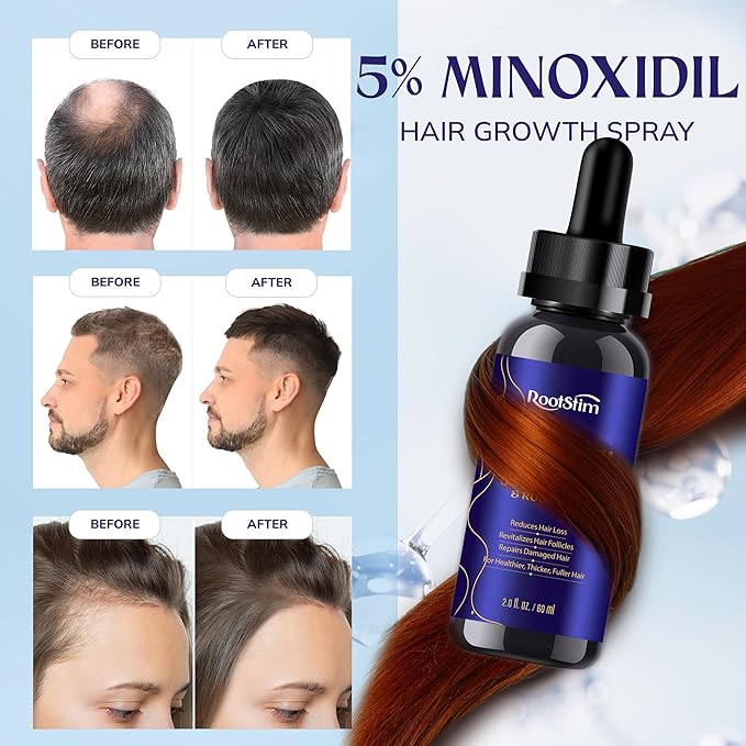 5% Minoxidil Hair Growth Kit for Men and Women: Extra Strength Minoxidil Hair Loss Treatment Serum with Rosemary for Faster Stronger Thicker Hair Growth 2 Fl Oz