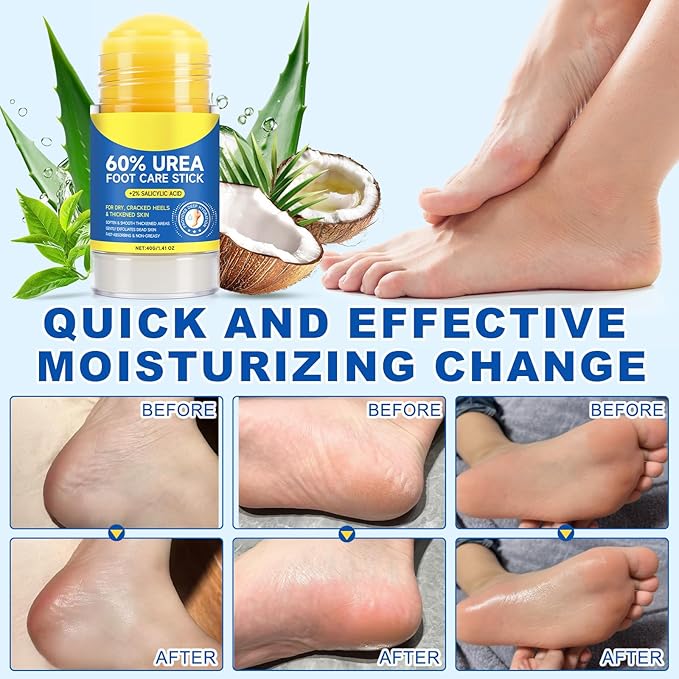 60% Urea Foot Care Stick with 2% Salicylic Acid, Foot Cream Moisturizer for Dry Cracked Feet, Knees, Elbows, Hands,Exfoliating Moisturizer, Dead Skin Remover Foot Balm 1.4oz (1)