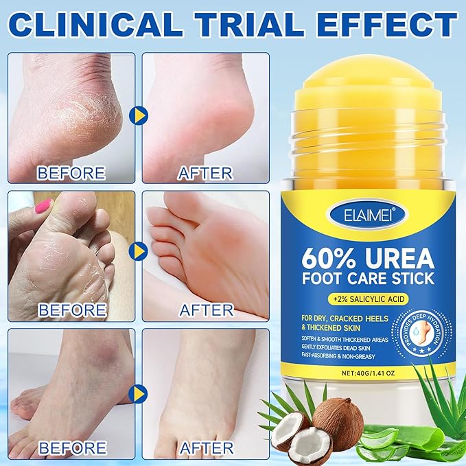 Urea Cream Stick 60% Plus 2% Salicylic Acid, Extra Strength Urea Foot Cream for Dry Cracked Heels, Callus Remover for Feet,Moisturizing Lotion for Hands, Knees,Elbows,Softens and Exfoliates Dead Skin