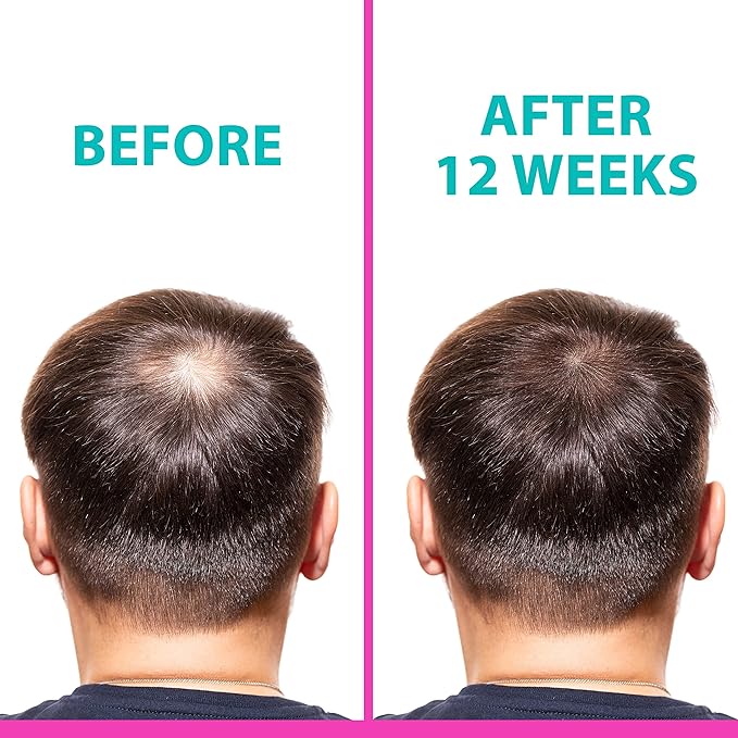 T2 Hair Loss Leave In Vials for Weak and Fine Hair - Natural Growth Oil Scalp Treatment for Women and Men - Intensive Root Strengthening Treatment with Peppermint, Rosemary